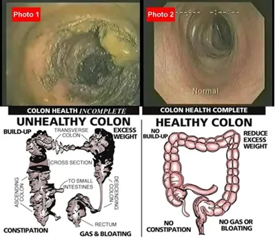 What is hydrotherapy colon cleansing?